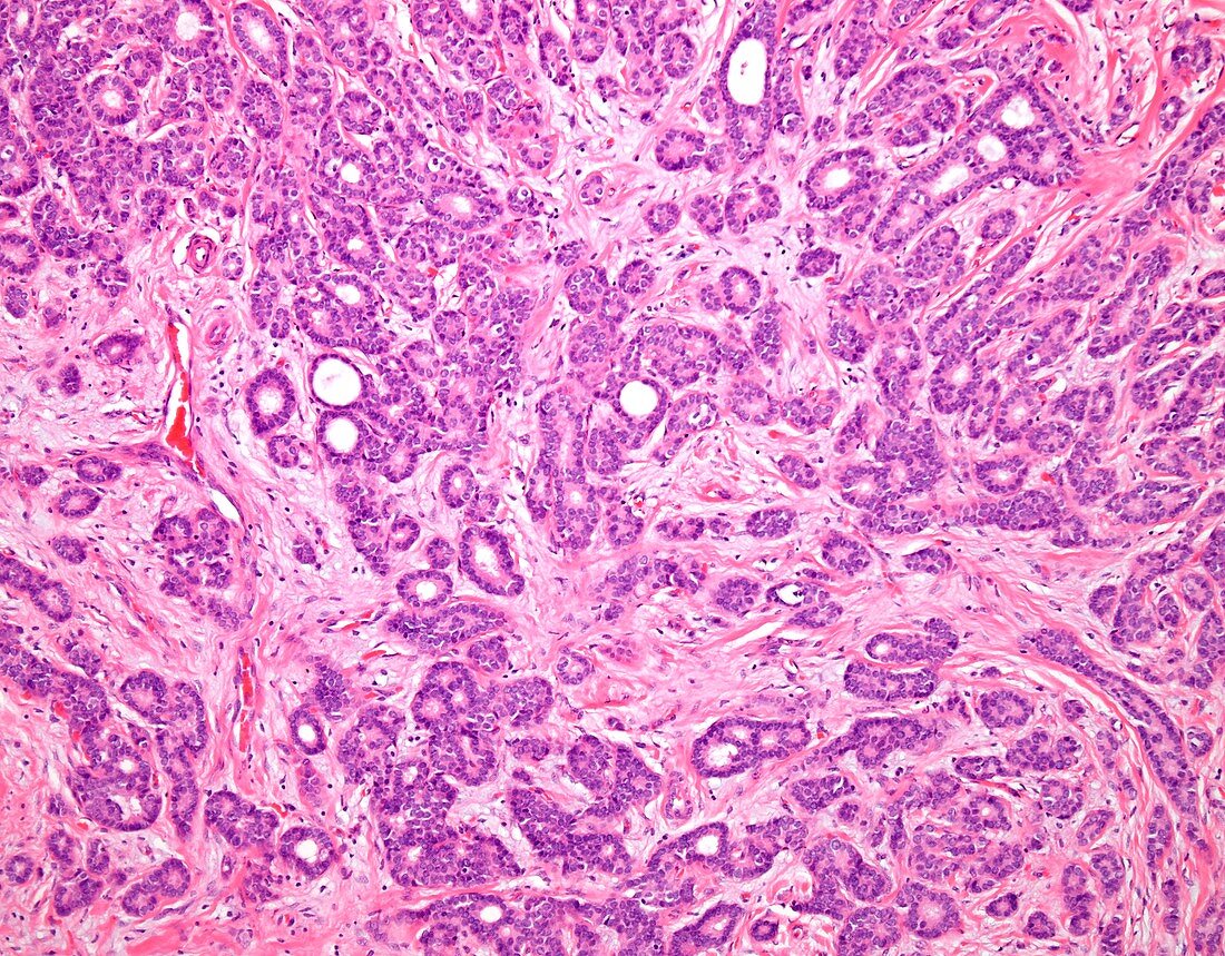 Low grade invasive ductal breast cancer, light micrograph