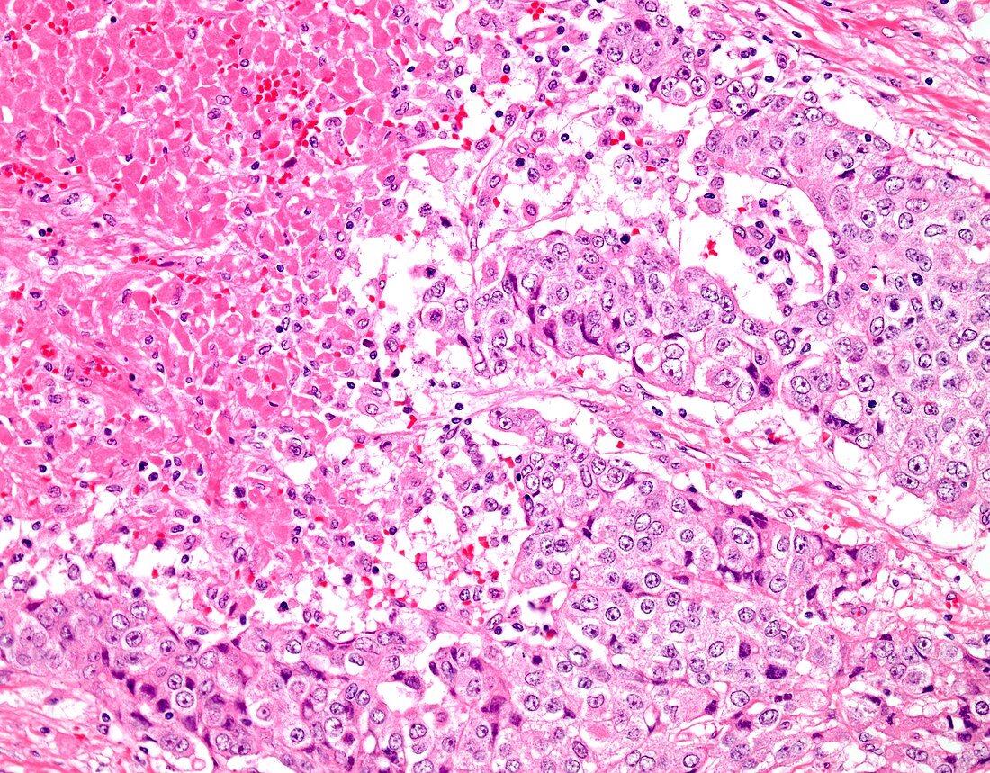 Necrotic invasive ductal breast cancer, light micrograph