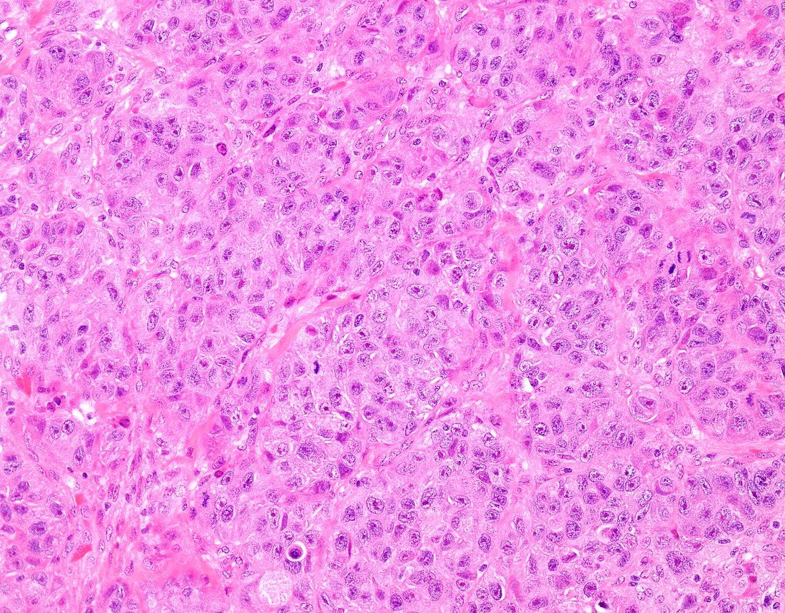 High grade invasive ductal breast cancer, light micrograph