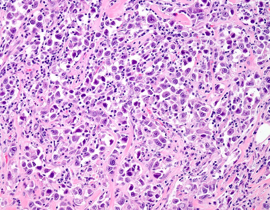 Pleomorphic lobular breast cancer, light micrograph