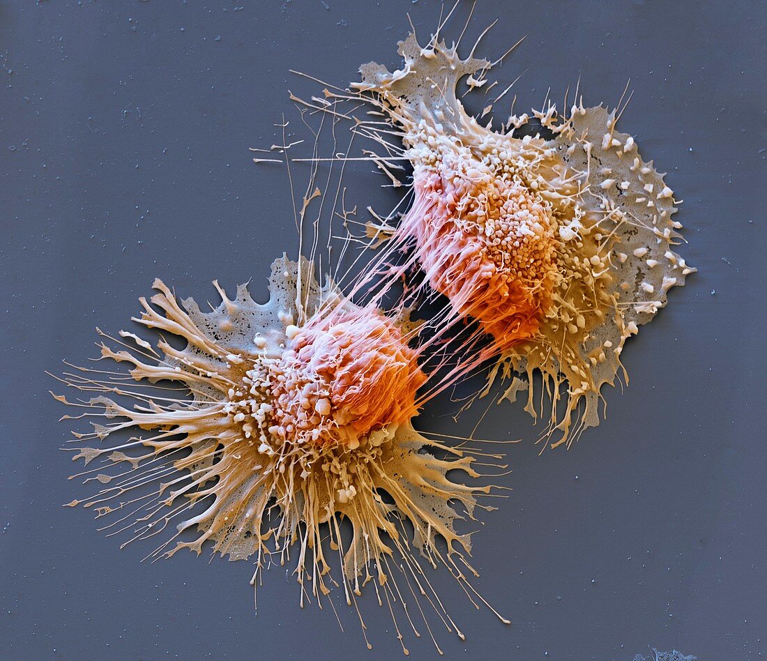 Dividing cancer cells, SEM
