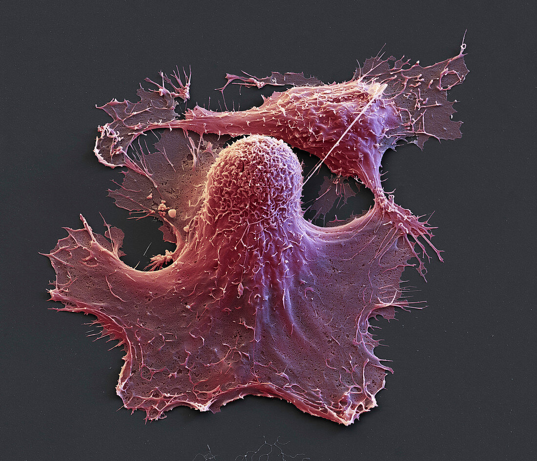 Brustkrebs-Zellen aus Kultur 2200:1