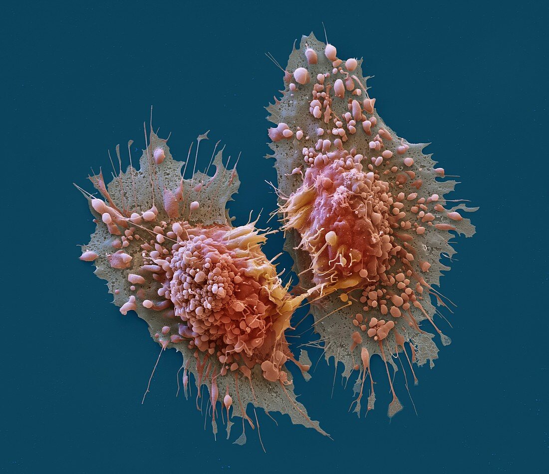 Cancer cells, SEM