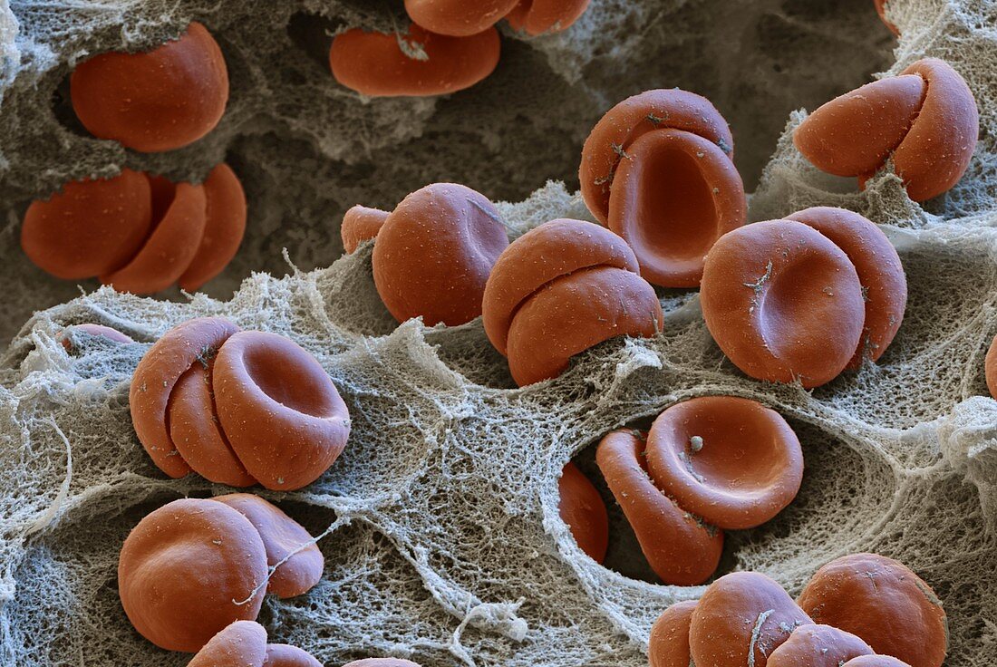 Thrombus mit Erythrozyten 4000:1