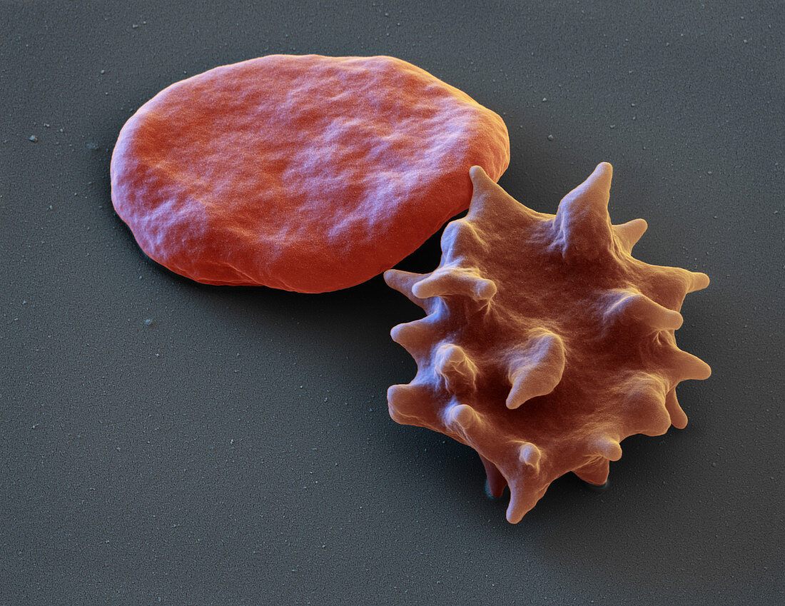 Normal and echinocyte red blood cells, SEM