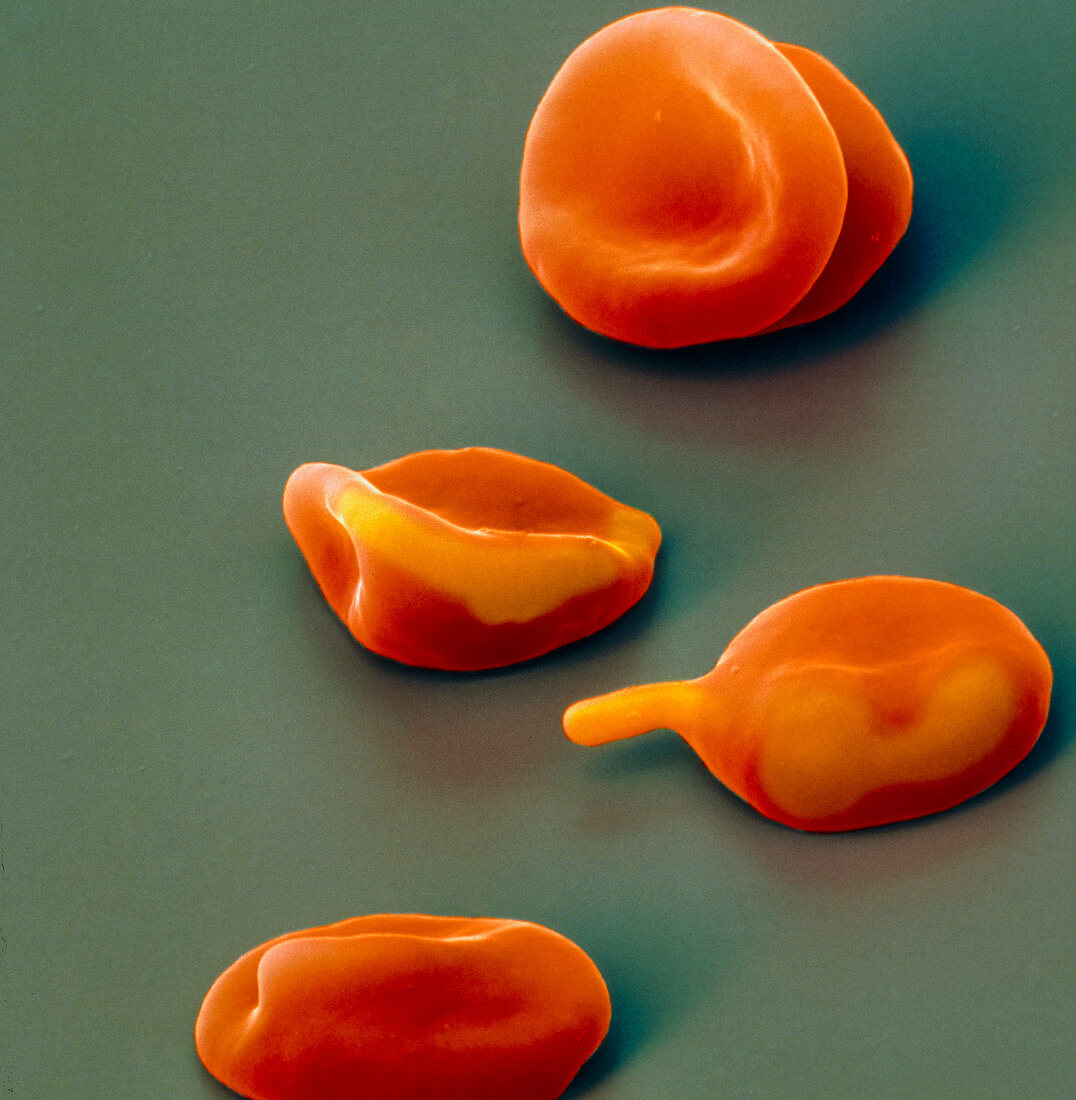 Coloured SEM of malaria-infected red blood cells