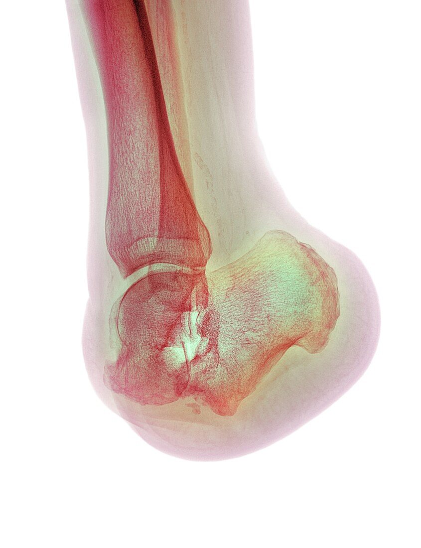 Amputated foot, X-ray