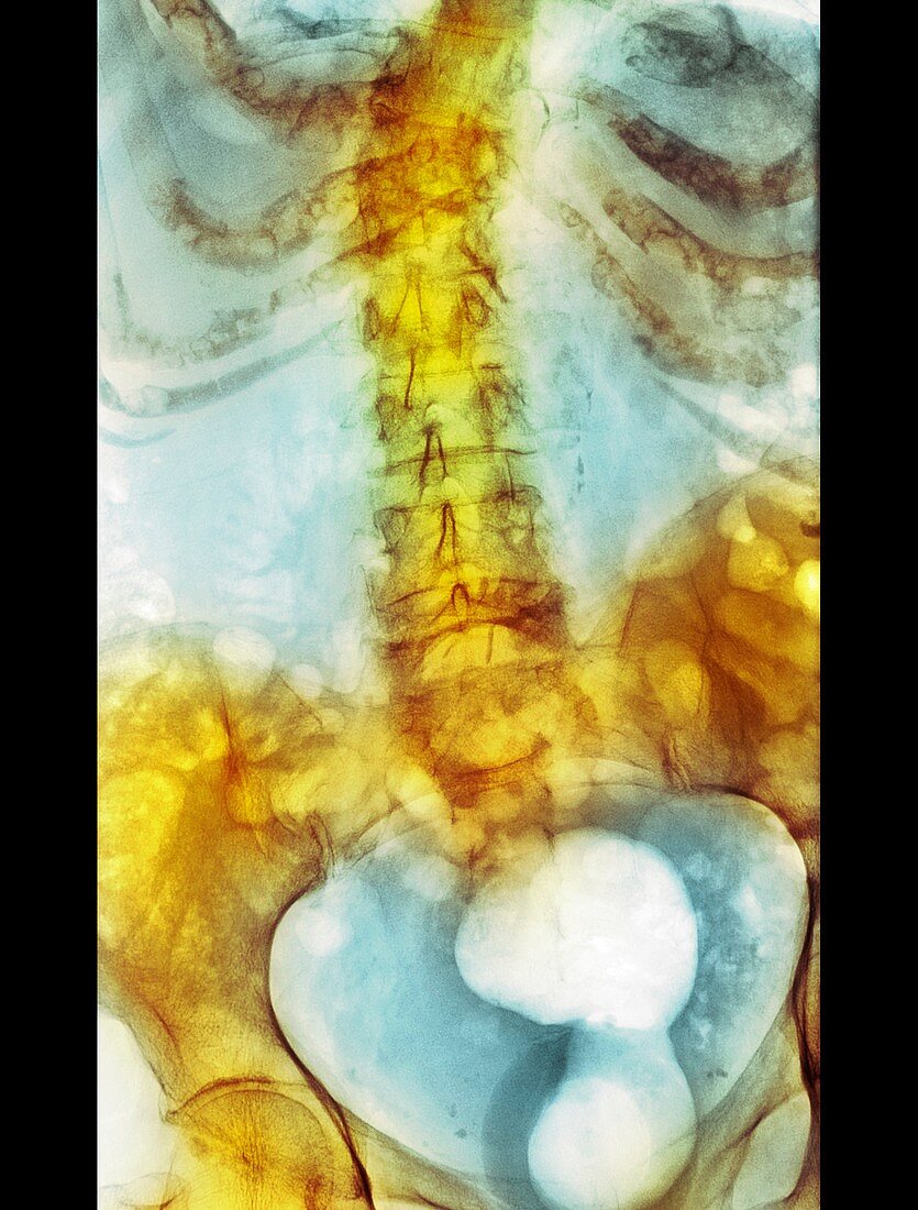 Spinal bone density reduction, X-ray