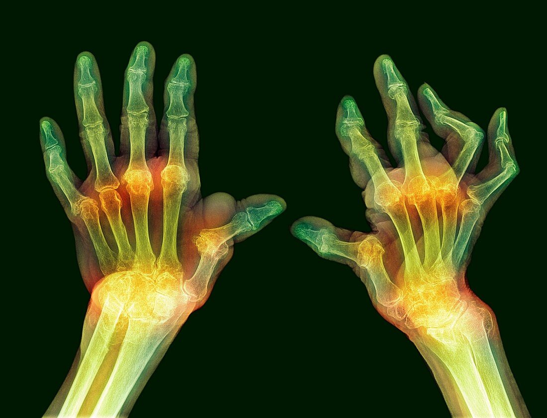 Rheumatoid arthritis of the hands, X-ray
