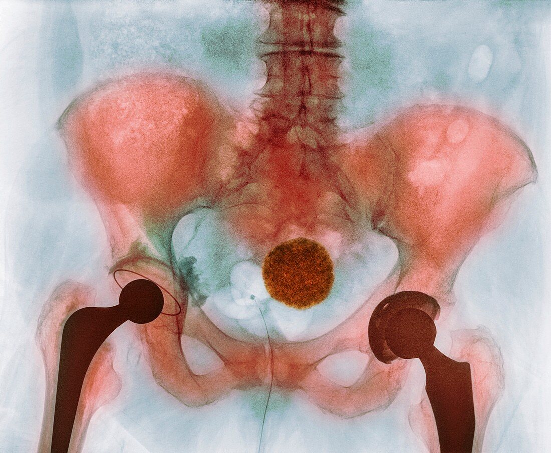 Calcified uterine fibroid