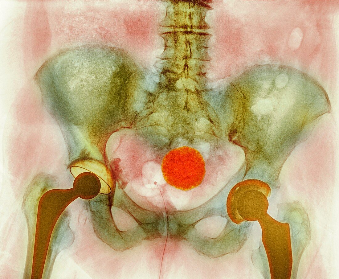 Calcified uterine fibroid