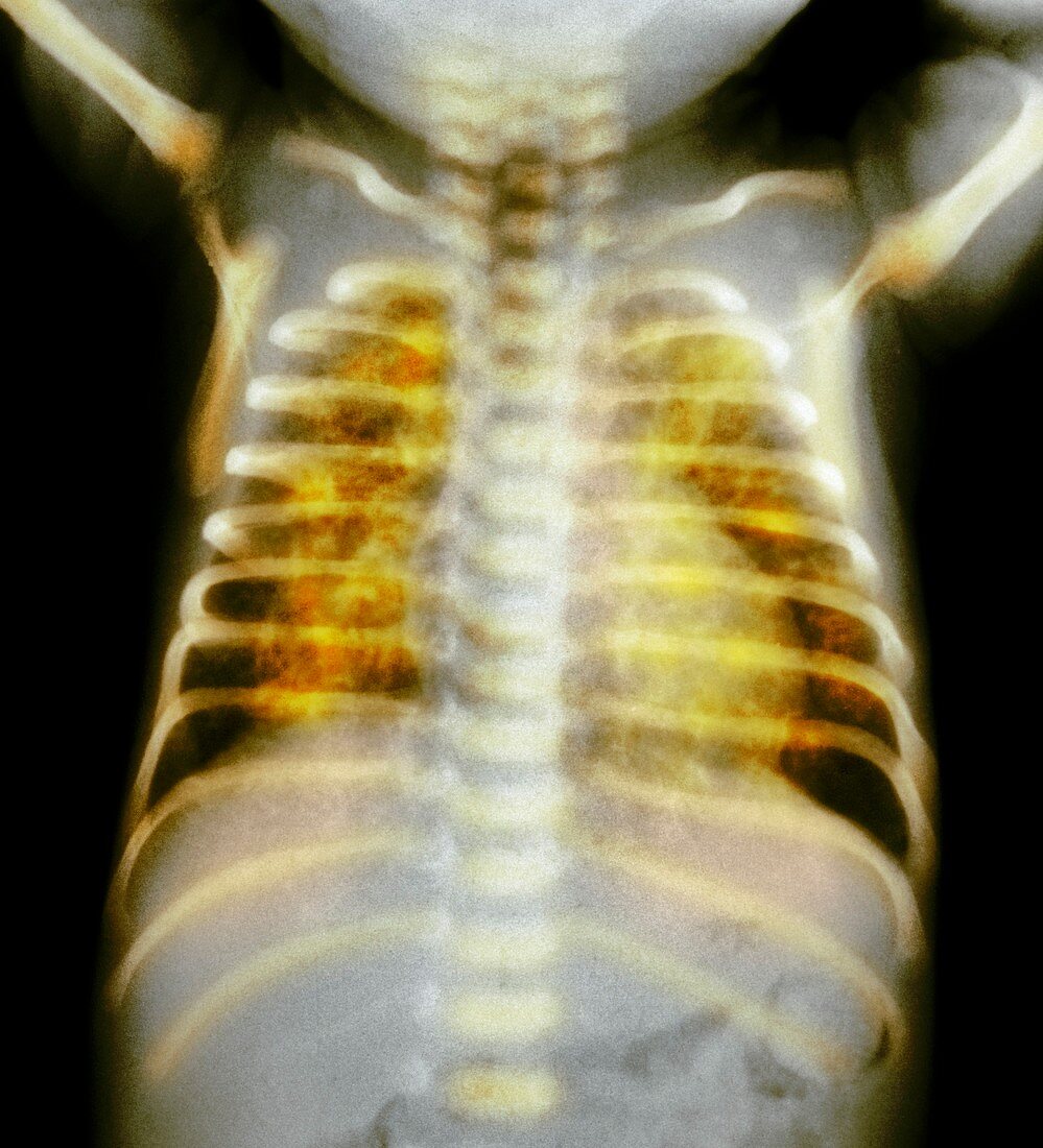 Wilson-Mikity syndrome, X-ray
