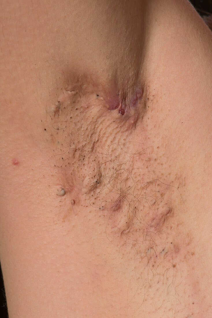Hidradenitis suppurativa of the armpit