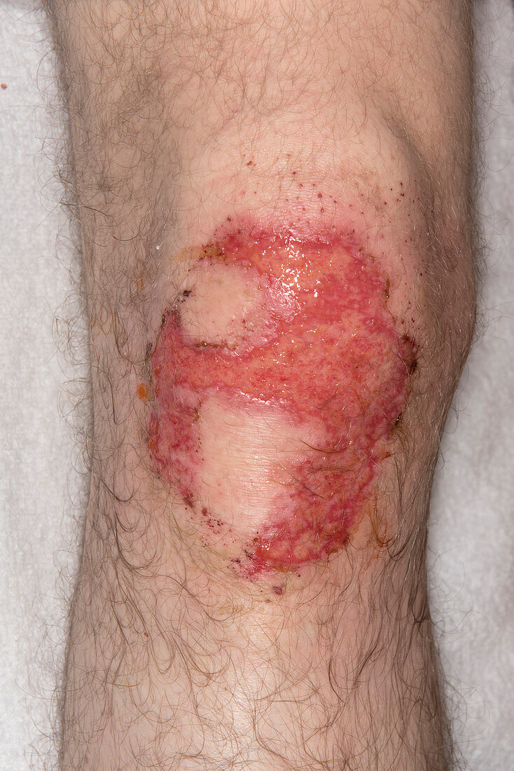 Chemical cement burn on knee