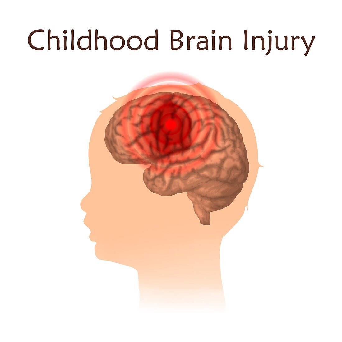 Childhood brain injury, illustration