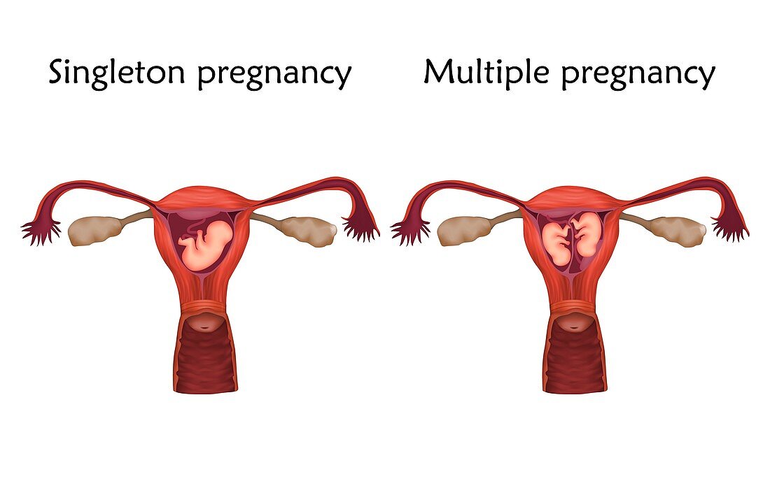 Multiple and singleton pregnancy, illustration