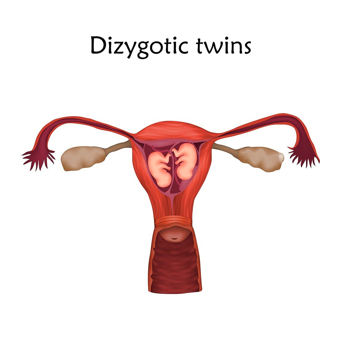 Dizygotic twins, illustration