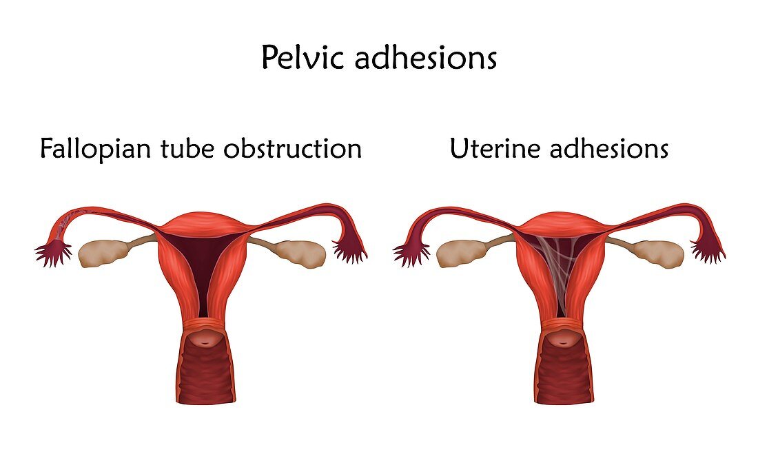Pelvic adhesions, illustration