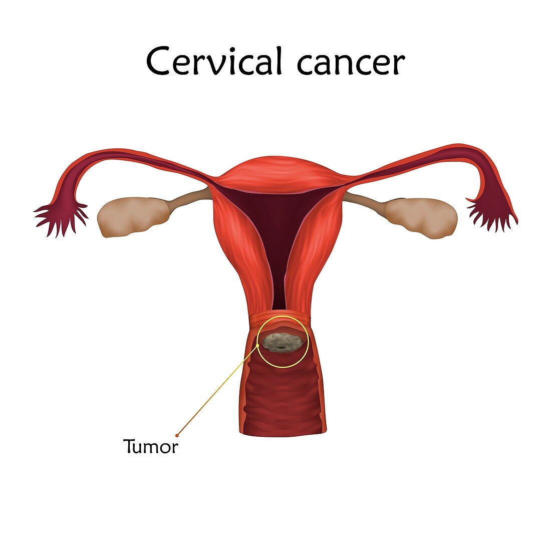Cervical cancer, illustration