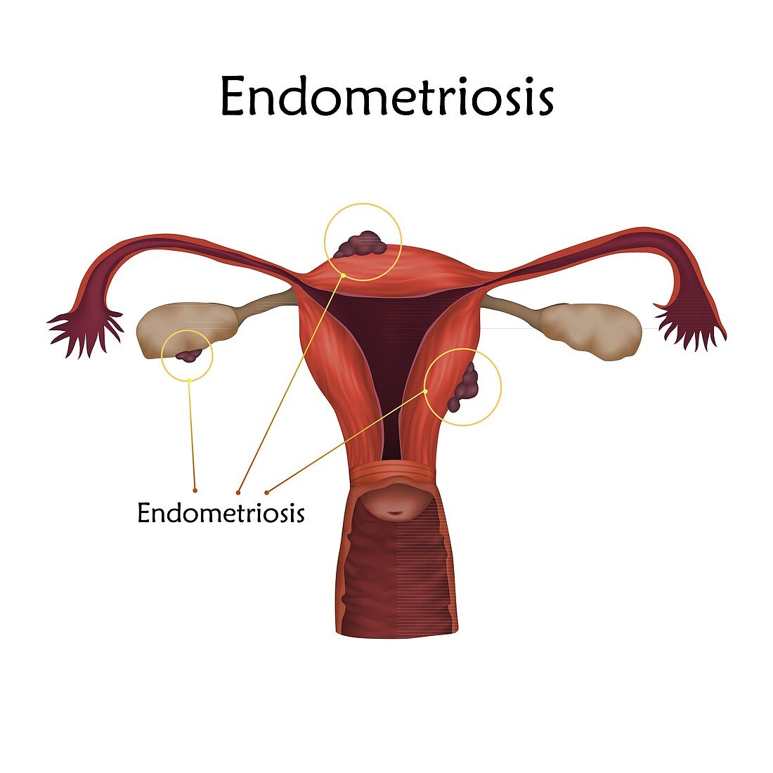 Endometriosis, illustration
