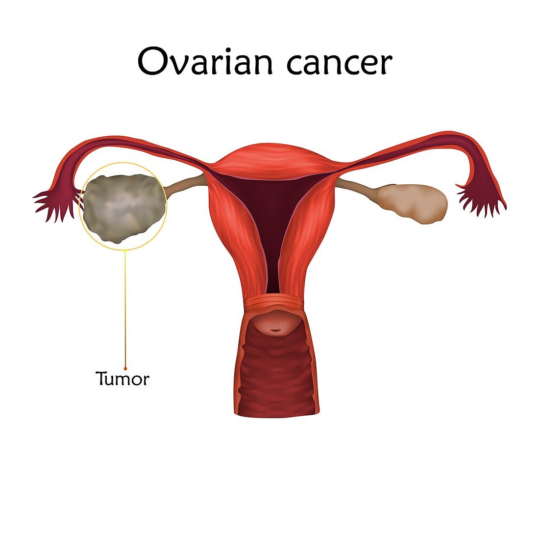 Ovarian cancer, illustration