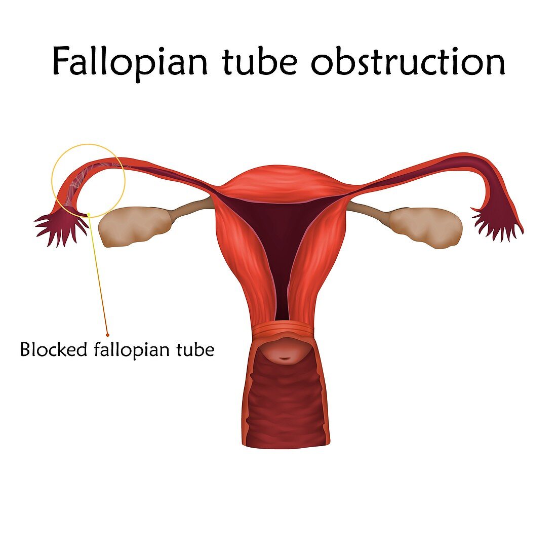 Fallopian tube obstruction, illustration