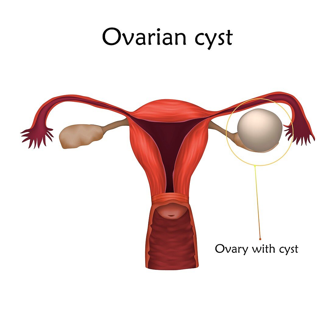 Ovarian cyst, illustration