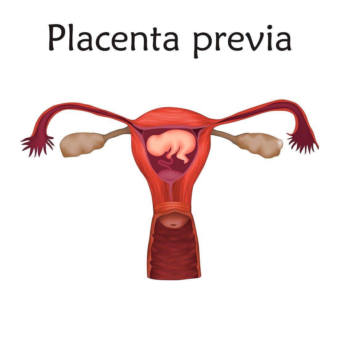 Placenta previa, illustration