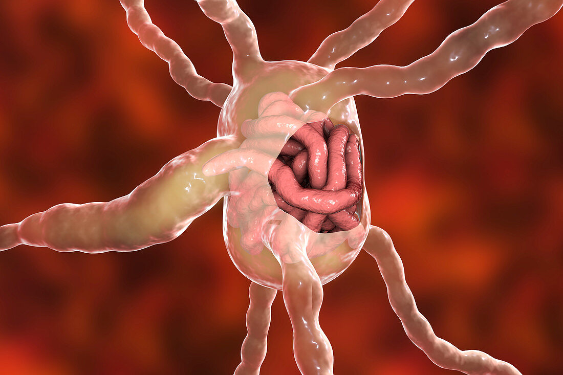 Lymph node with filaria worms, illustration