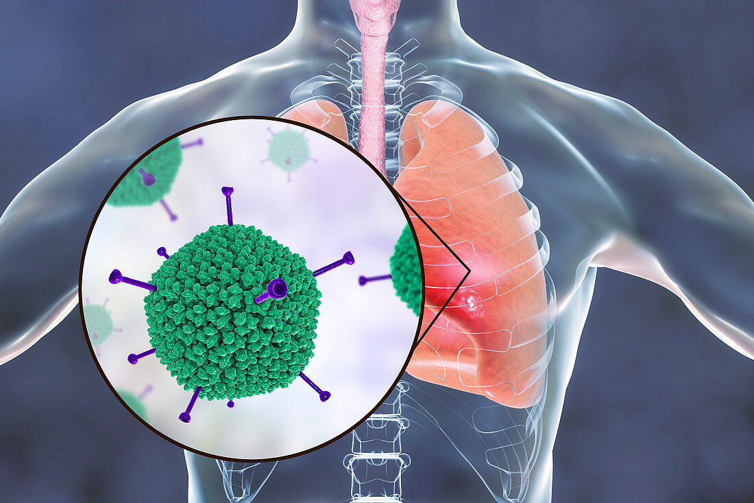 Adenoviral infection of lungs, illustration