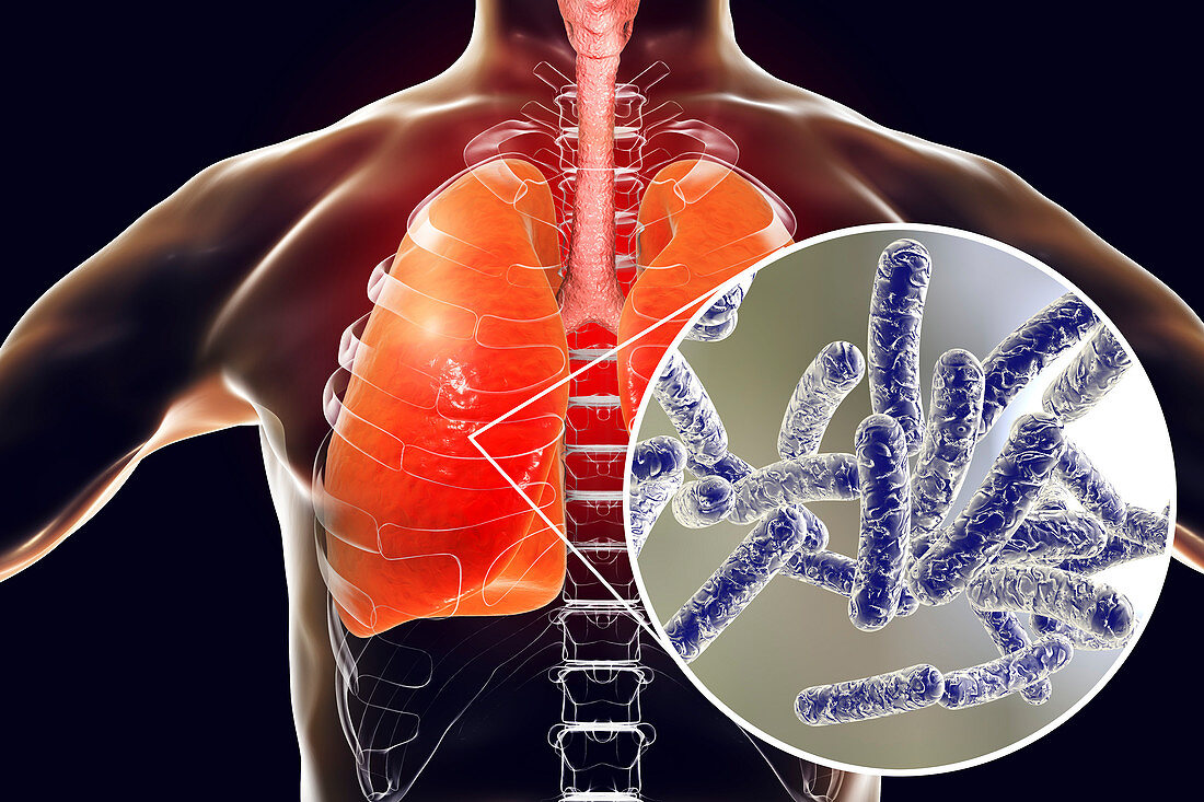 Legionnaires' disease, conceptual illustration