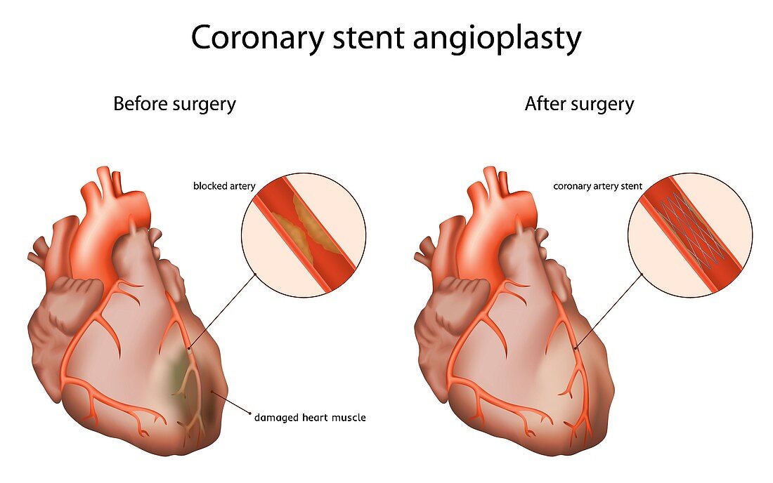 Coronary stent angioplasty, illustration