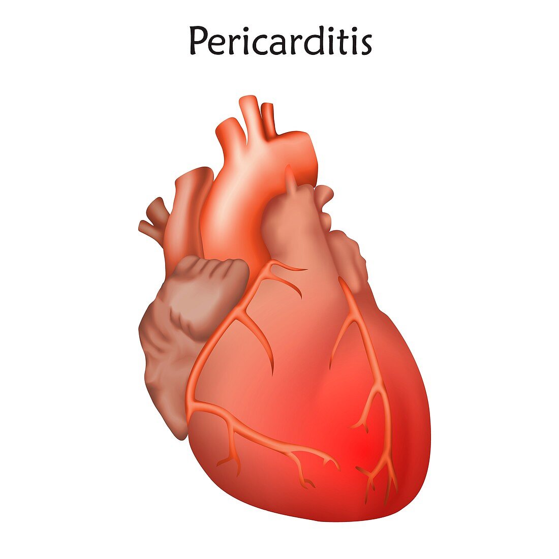 Pericarditis, illustration