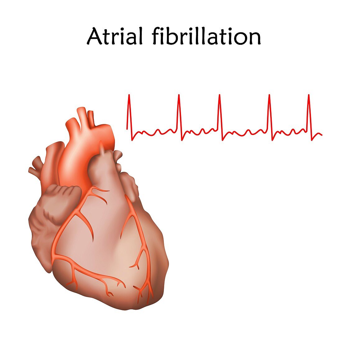 Atrial fibrillation, illustration