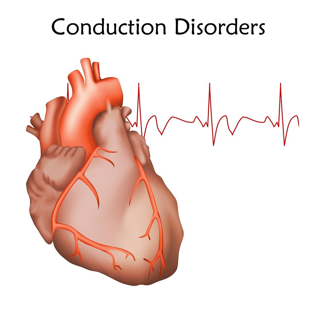 Heart conduction disorders, illustration