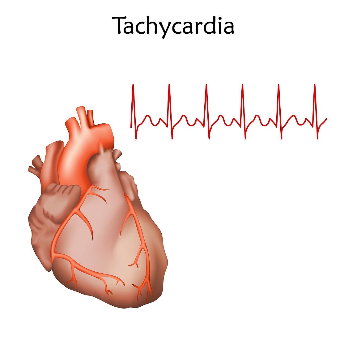 Tachycardia, illustration