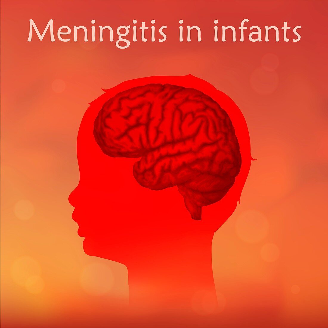 Childhood meningitis, illustration