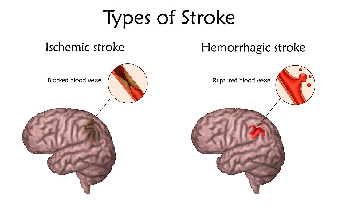 Stroke types, illustration