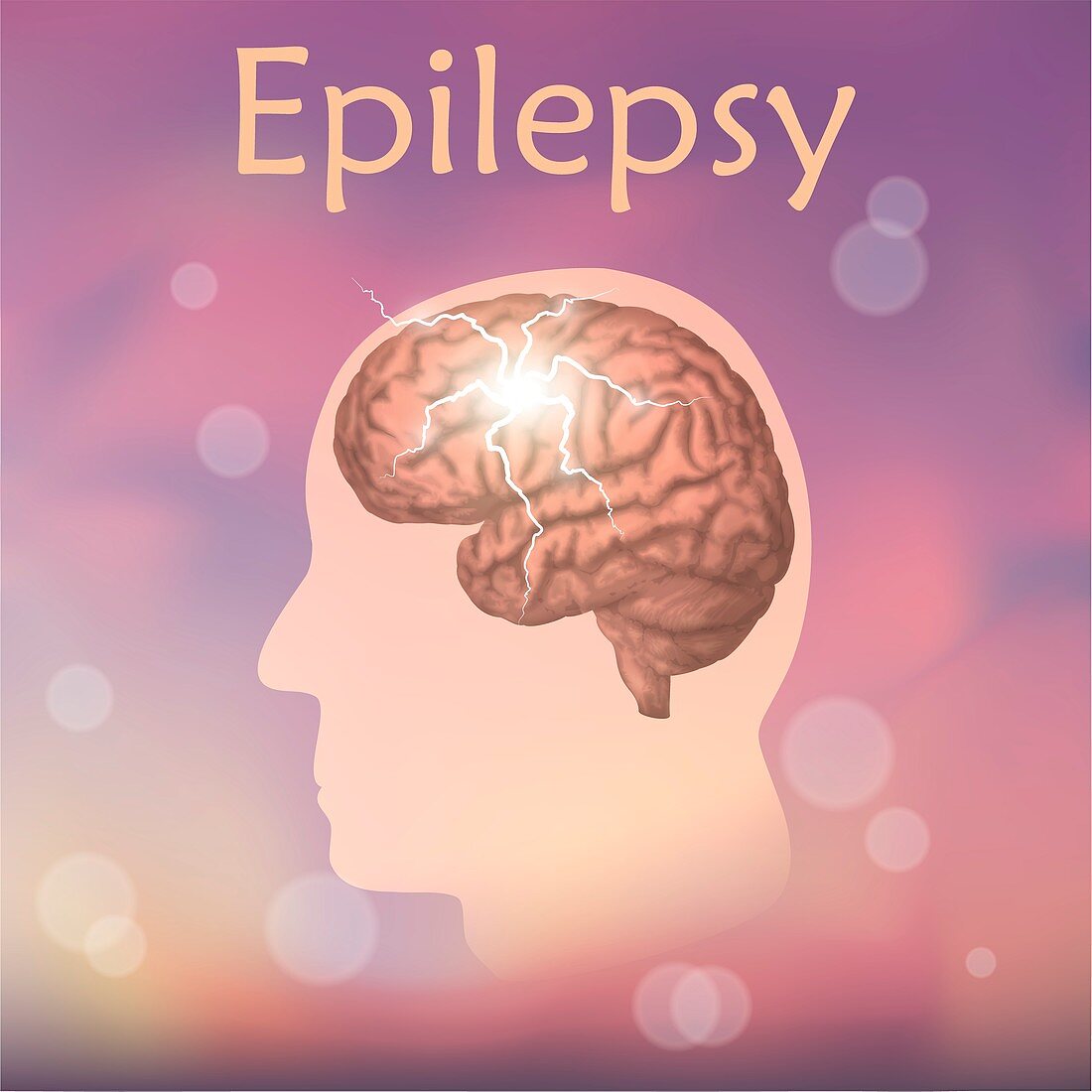 Epilepsy, illustration