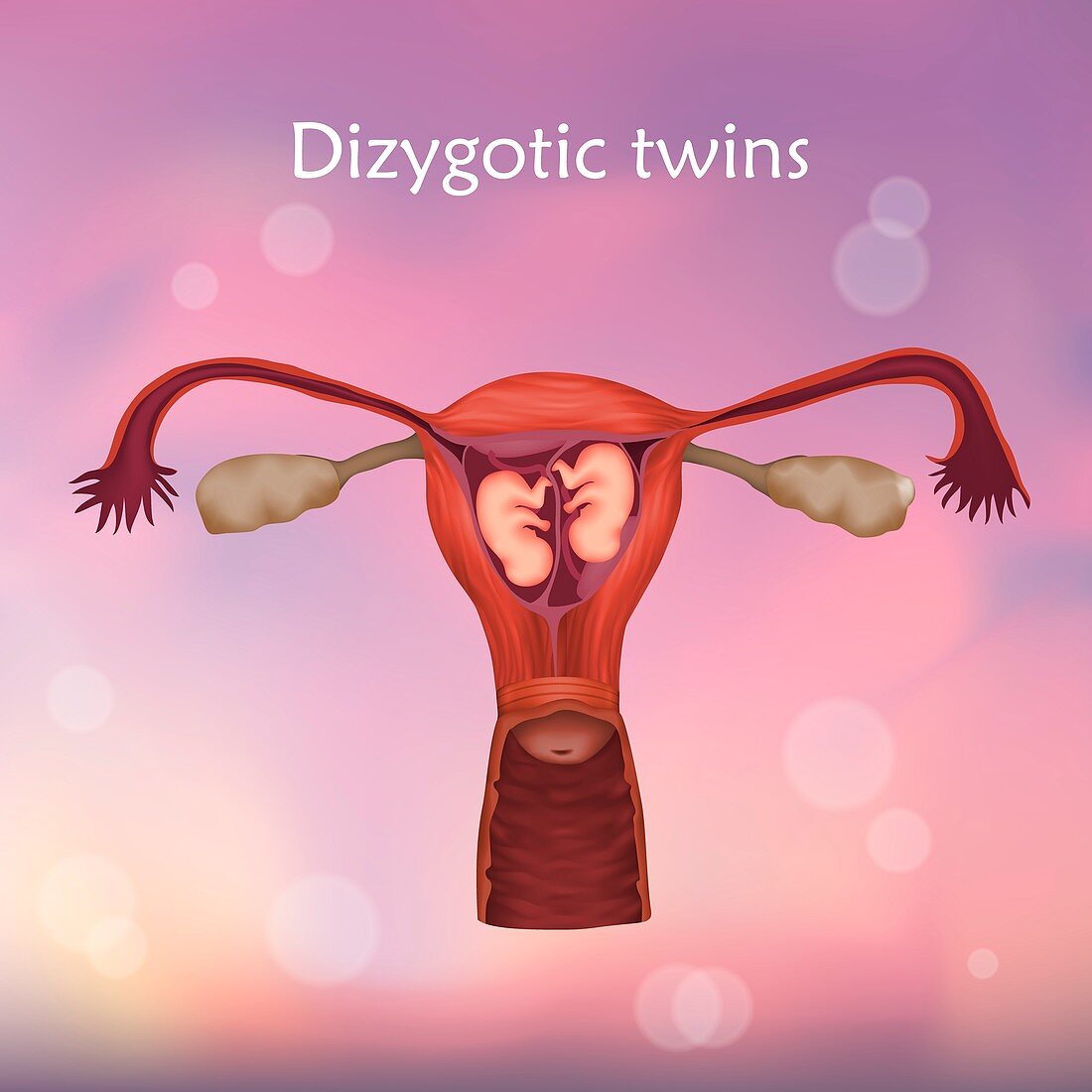 Dizygotic twins, illustration