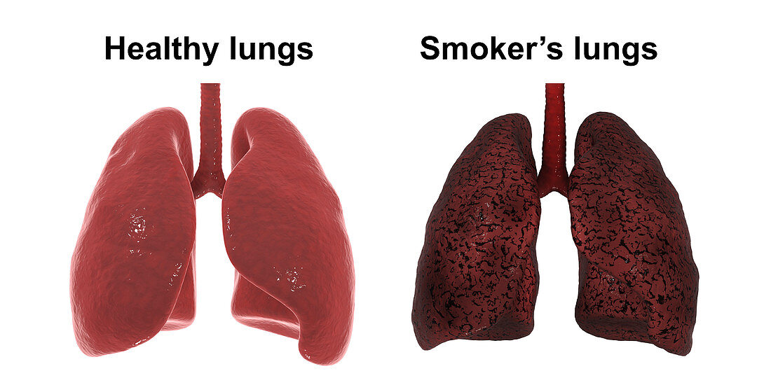 Healthy and smoker's lungs, illustration