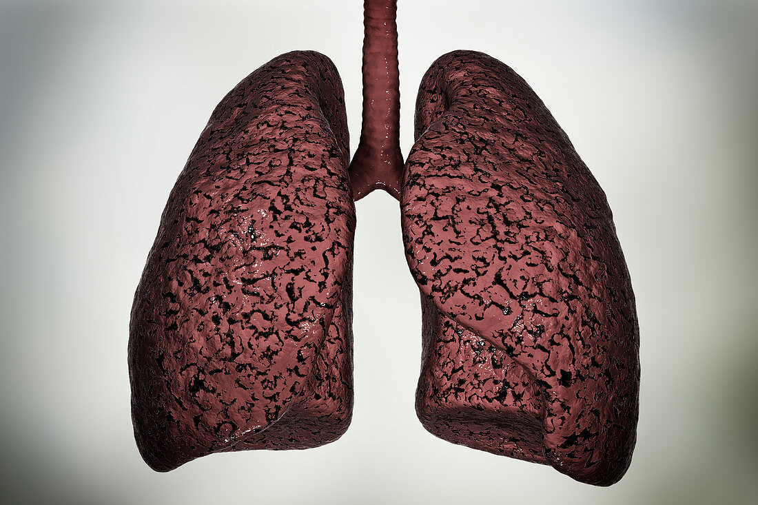Smoker's lungs, illustration
