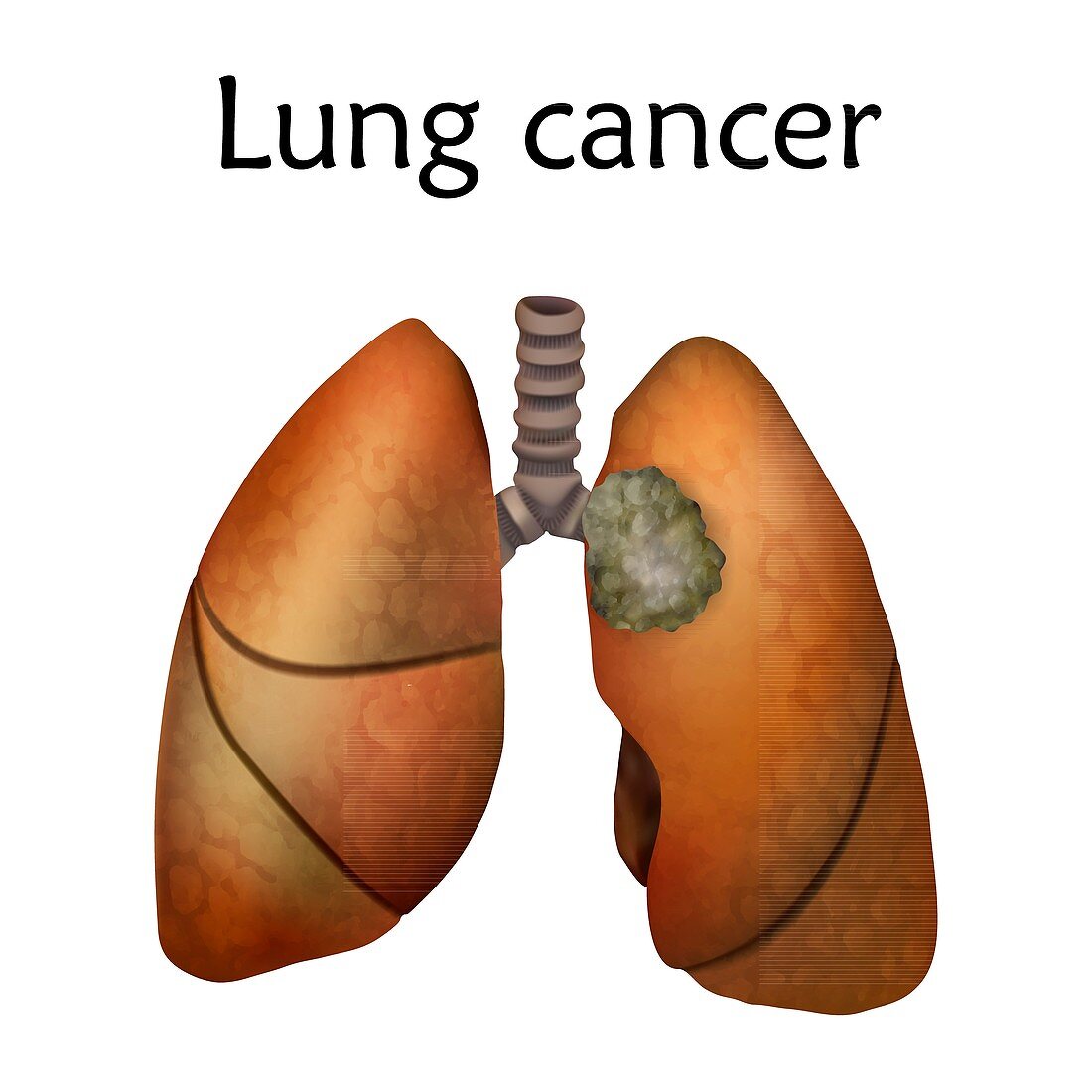 Lung cancer, illustration