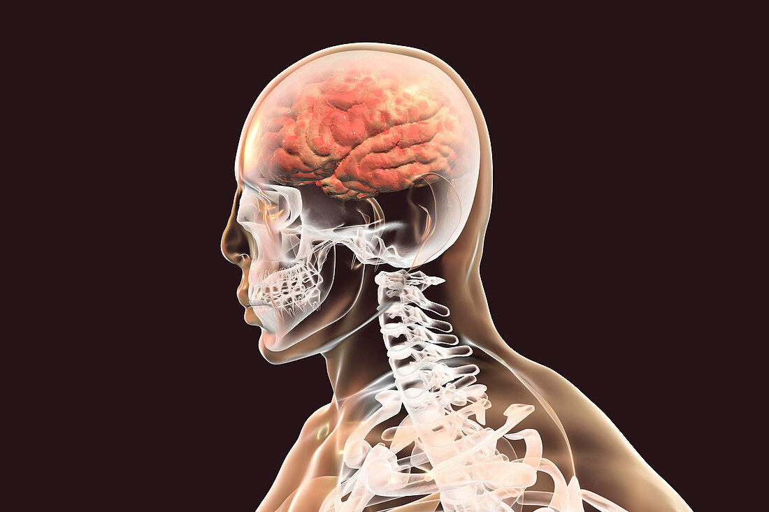 Brain with encephalitis, illustration