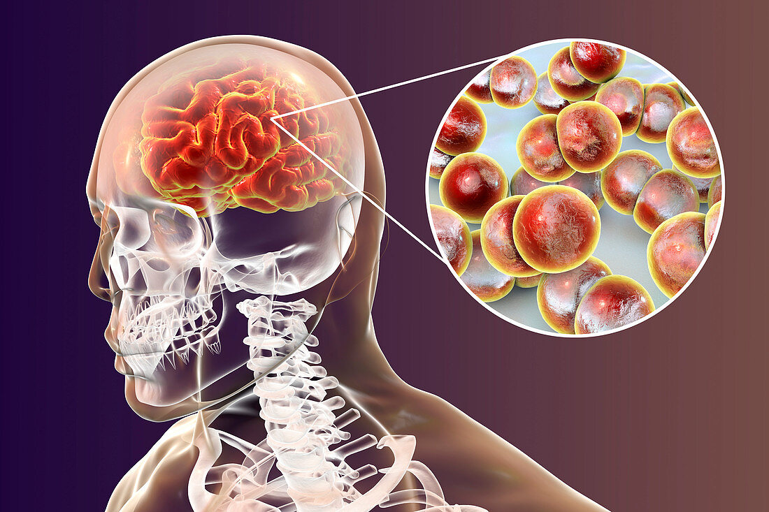 Neisseria meningitidis brain infection, illustration