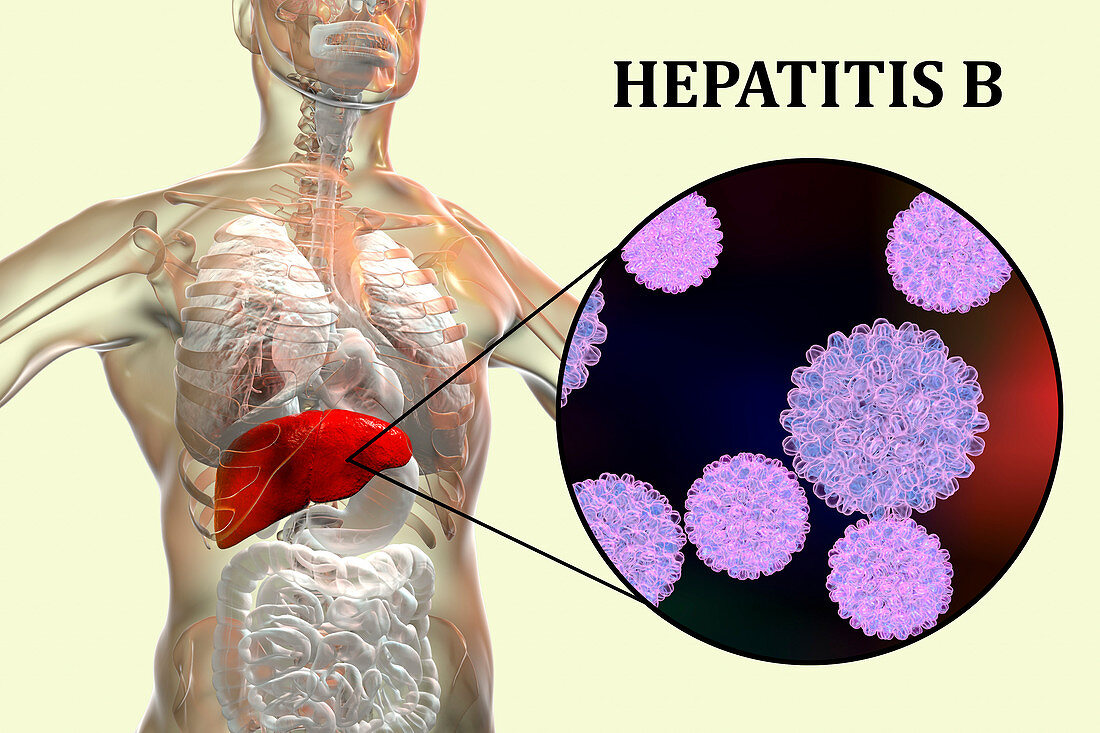 Hepatitis B infection, illustration