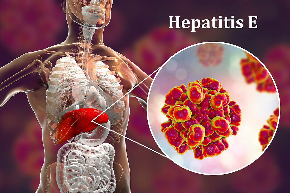 Hepatitis E infection, illustration