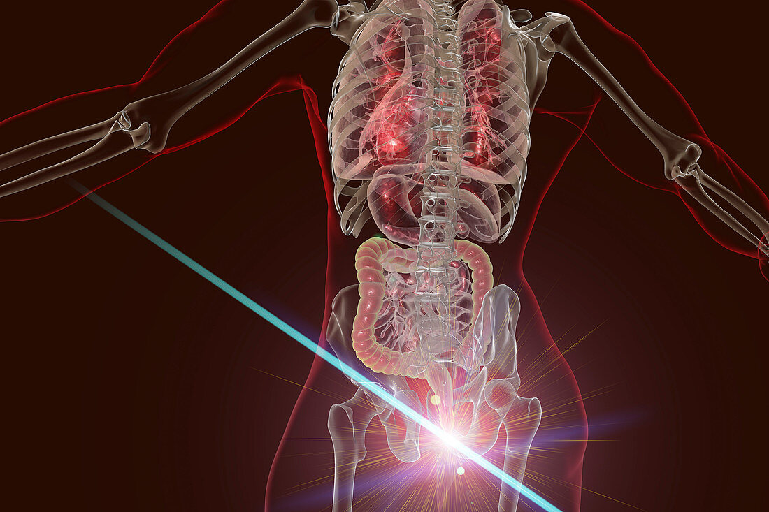 Laser treatment of haemorrhoids, conceptual illustration