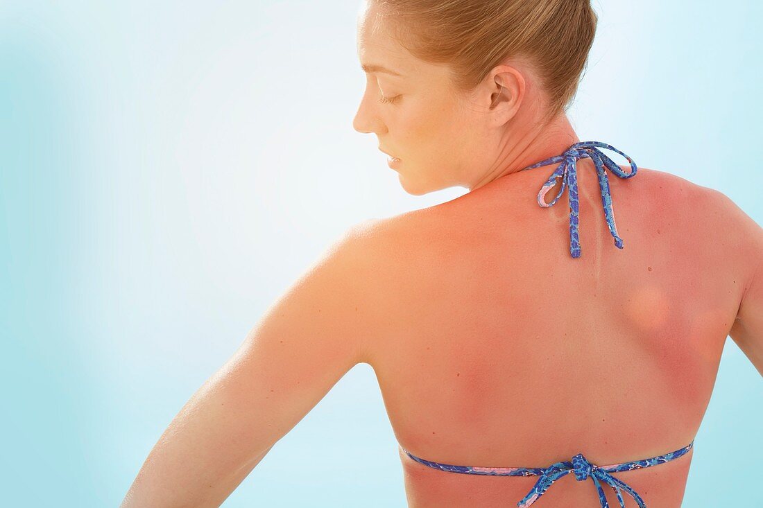 Woman with sunburnt back