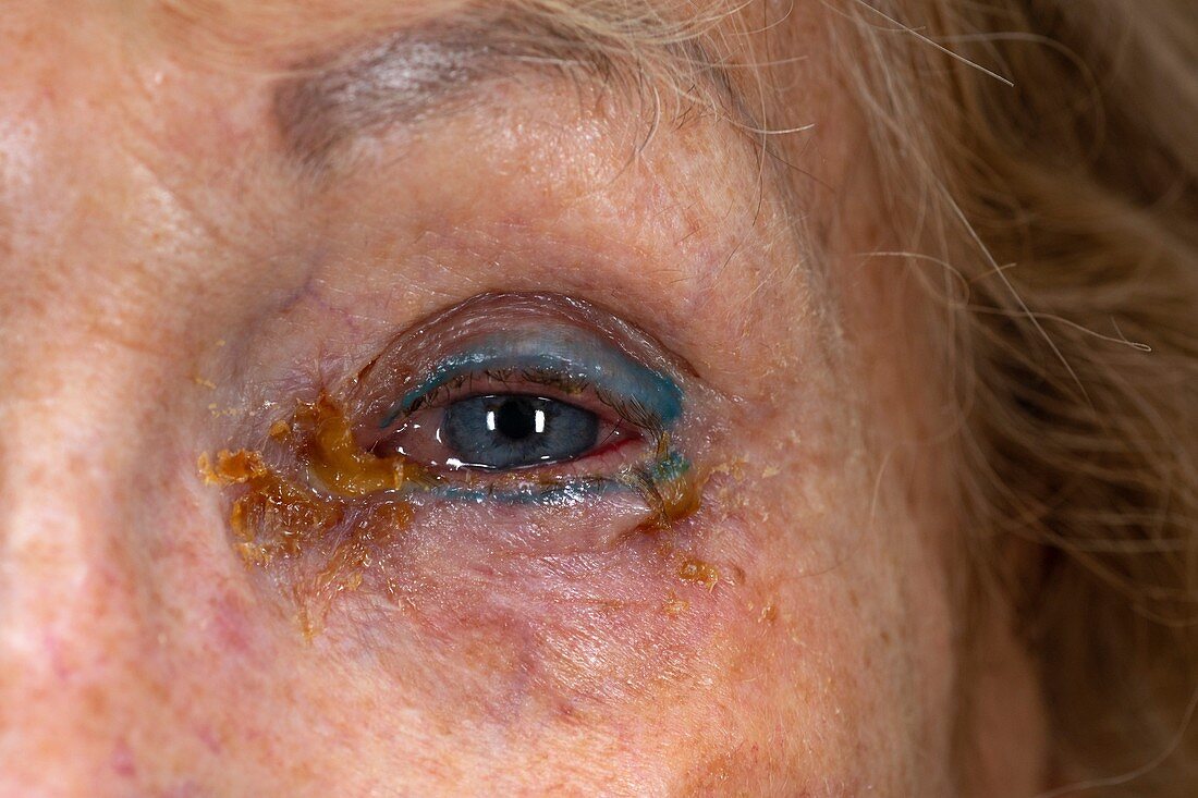 Crusting around infected eye